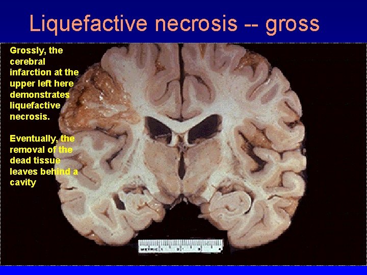 Liquefactive necrosis -- gross Grossly, the cerebral infarction at the upper left here demonstrates