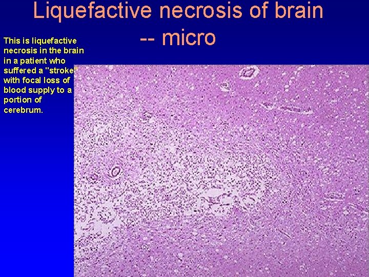 Liquefactive necrosis of brain -- micro This is liquefactive necrosis in the brain in