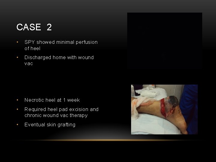 CASE 2 • SPY showed minimal perfusion of heel • Discharged home with wound
