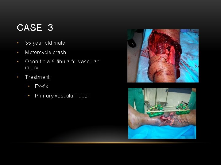 CASE 3 • 35 year old male • Motorcycle crash • Open tibia &