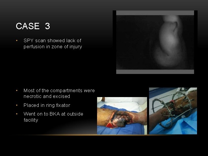 CASE 3 • SPY scan showed lack of perfusion in zone of injury •