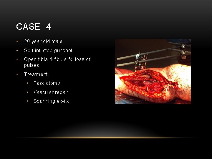 CASE 4 • 20 year old male • Self-inflicted gunshot • Open tibia &