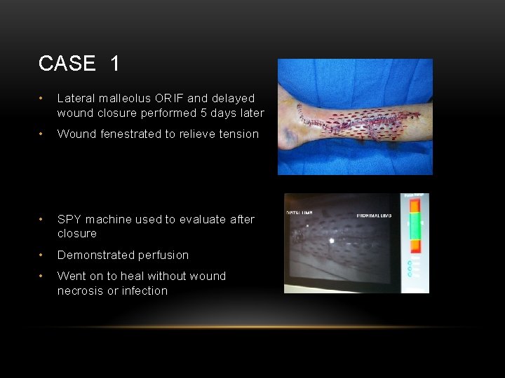 CASE 1 • Lateral malleolus ORIF and delayed wound closure performed 5 days later
