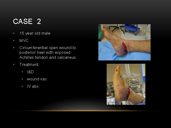 CASE 2 • 15 year old male • MVC • Circumferential open wound to