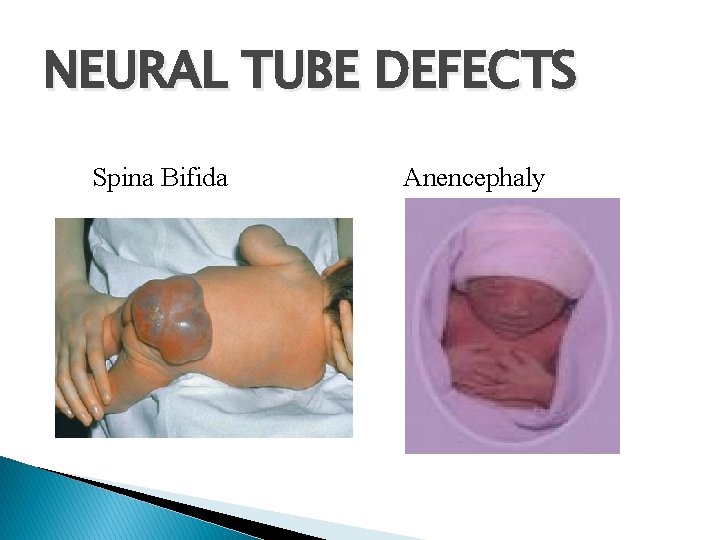 NEURAL TUBE DEFECTS Spina Bifida Anencephaly 