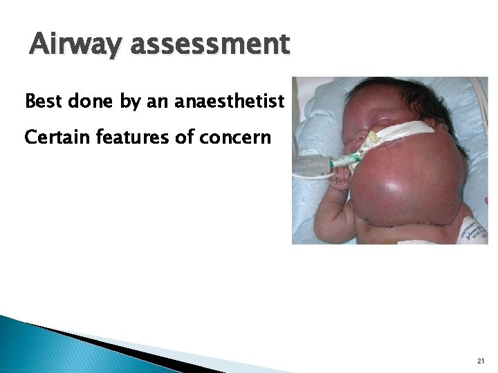 Airway assessment Best done by an anaesthetist Certain features of concern 21 