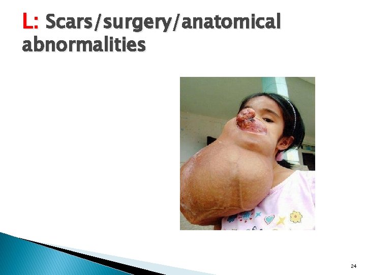 L: Scars/surgery/anatomical abnormalities 24 