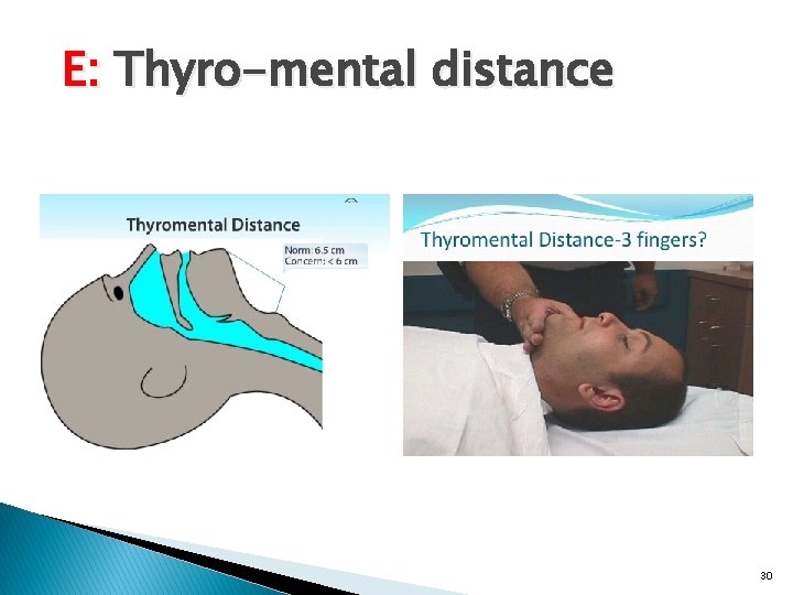 E: Thyro-mental distance 30 