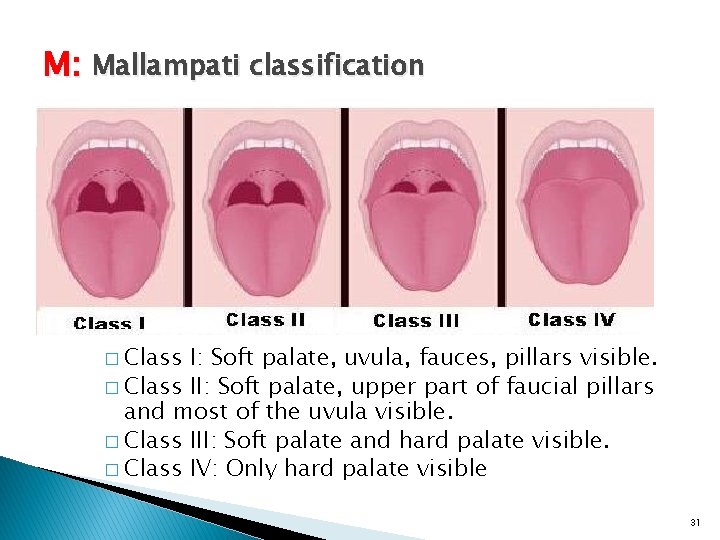 M: Mallampati classification � Class I: Soft palate, uvula, fauces, pillars visible. � Class