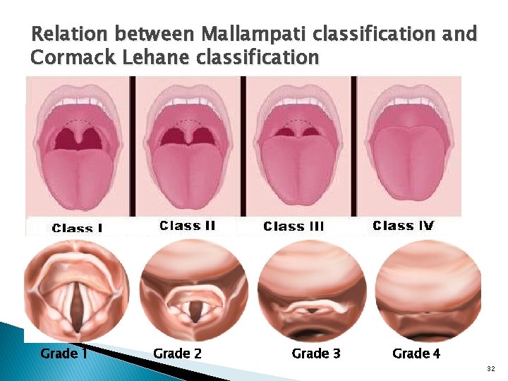 Relation between Mallampati classification and Cormack Lehane classification Grade 1 Grade 2 Grade 3