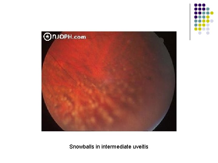 Snowballs in intermediate uveitis 