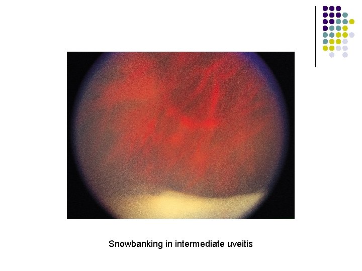 Snowbanking in intermediate uveitis 