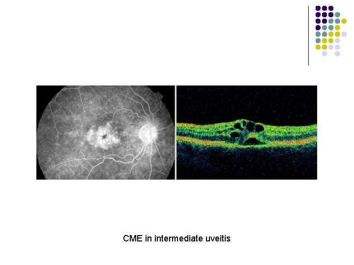 CME in intermediate uveitis 