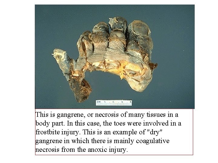 This is gangrene, or necrosis of many tissues in a body part. In this