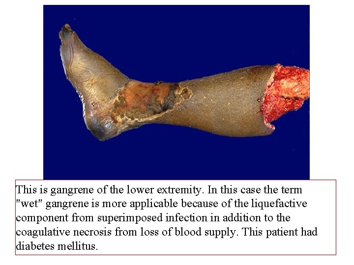 This is gangrene of the lower extremity. In this case the term "wet" gangrene