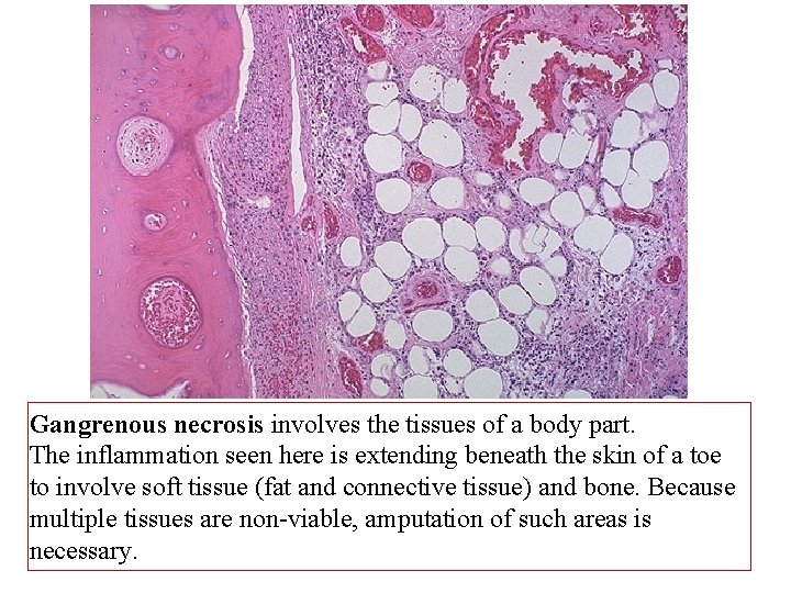 Gangrenous necrosis involves the tissues of a body part. The inflammation seen here is