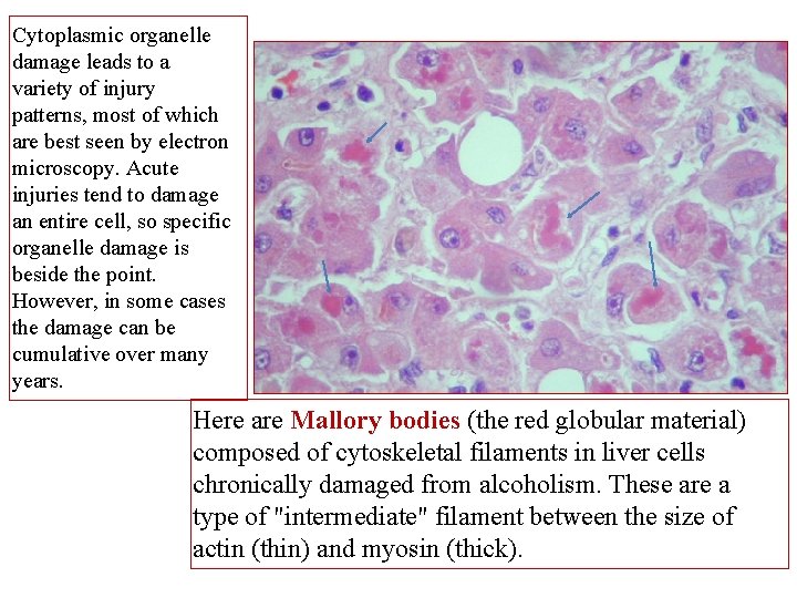 Cytoplasmic organelle damage leads to a variety of injury patterns, most of which are