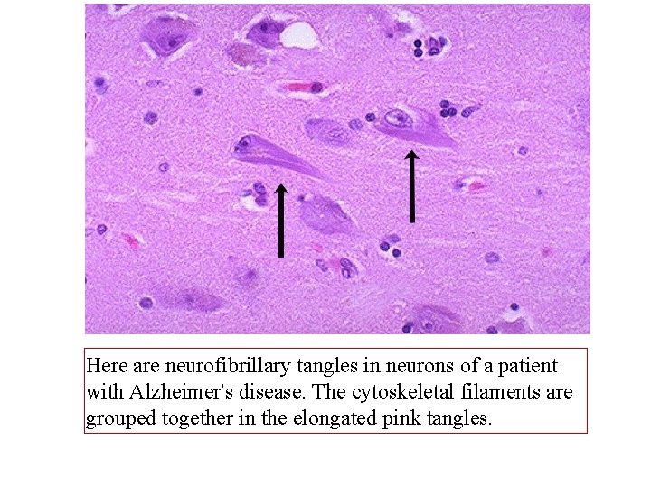 Here are neurofibrillary tangles in neurons of a patient with Alzheimer's disease. The cytoskeletal