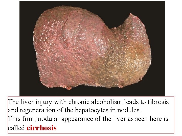 The liver injury with chronic alcoholism leads to fibrosis and regeneration of the hepatocytes