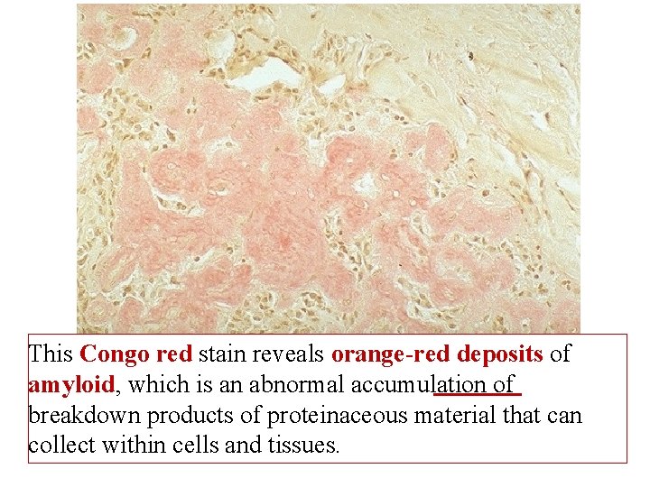 This Congo red stain reveals orange-red deposits of amyloid, which is an abnormal accumulation