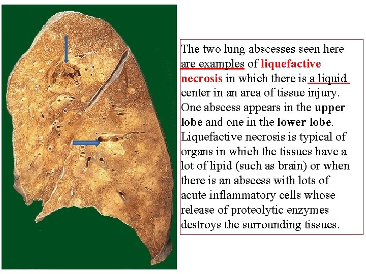 The two lung abscesses seen here are examples of liquefactive necrosis in which there