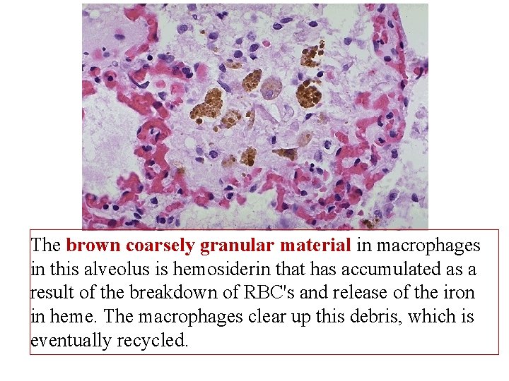 The brown coarsely granular material in macrophages in this alveolus is hemosiderin that has