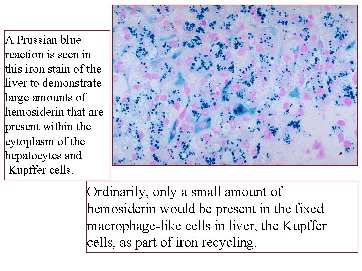 A Prussian blue reaction is seen in this iron stain of the liver to