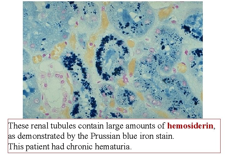 These renal tubules contain large amounts of hemosiderin, as demonstrated by the Prussian blue