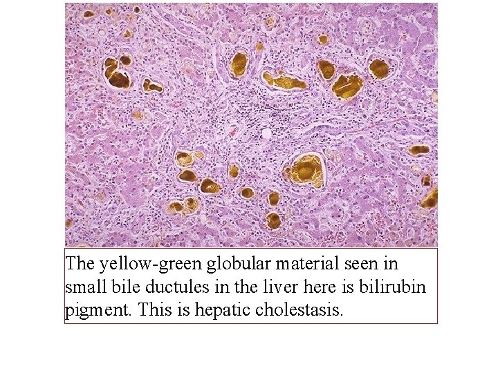 The yellow-green globular material seen in small bile ductules in the liver here is
