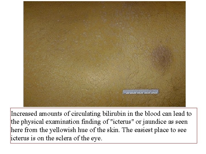 Increased amounts of circulating bilirubin in the blood can lead to the physical examination