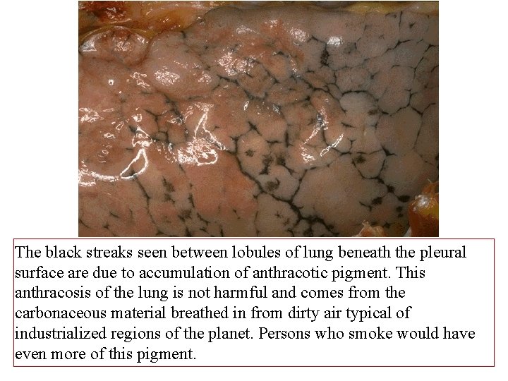 The black streaks seen between lobules of lung beneath the pleural surface are due