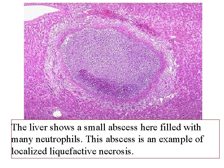 The liver shows a small abscess here filled with many neutrophils. This abscess is