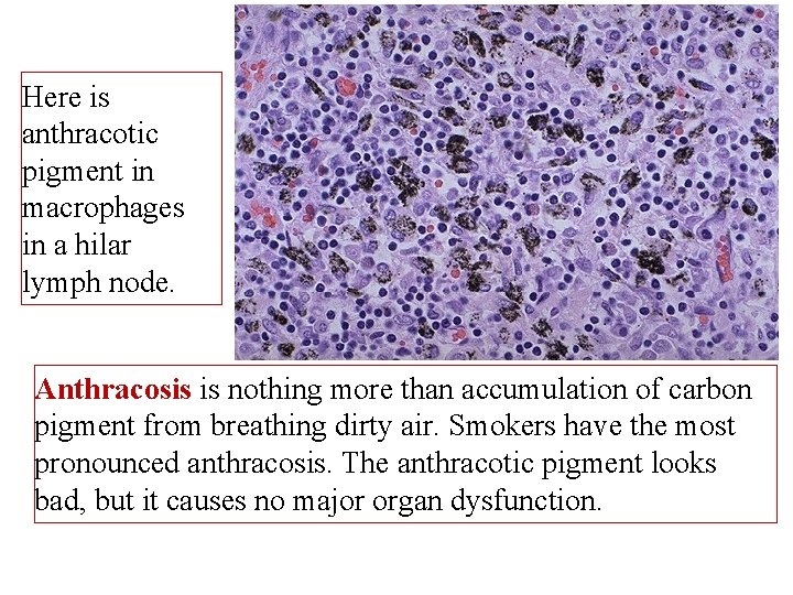 Here is anthracotic pigment in macrophages in a hilar lymph node. Anthracosis is nothing