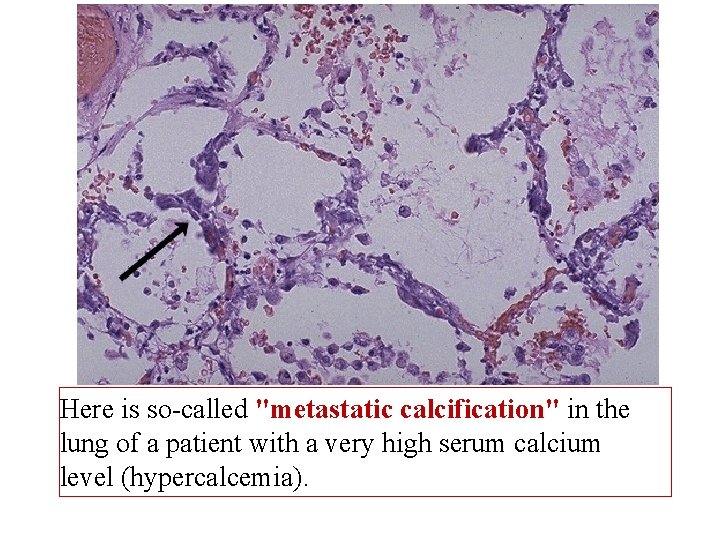 Here is so-called "metastatic calcification" in the lung of a patient with a very