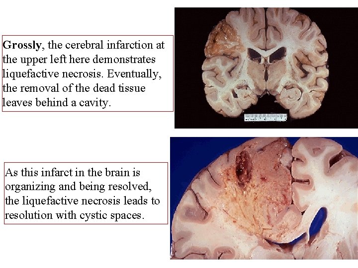 Grossly, the cerebral infarction at the upper left here demonstrates liquefactive necrosis. Eventually, the