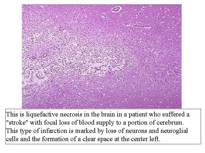 This is liquefactive necrosis in the brain in a patient who suffered a "stroke"