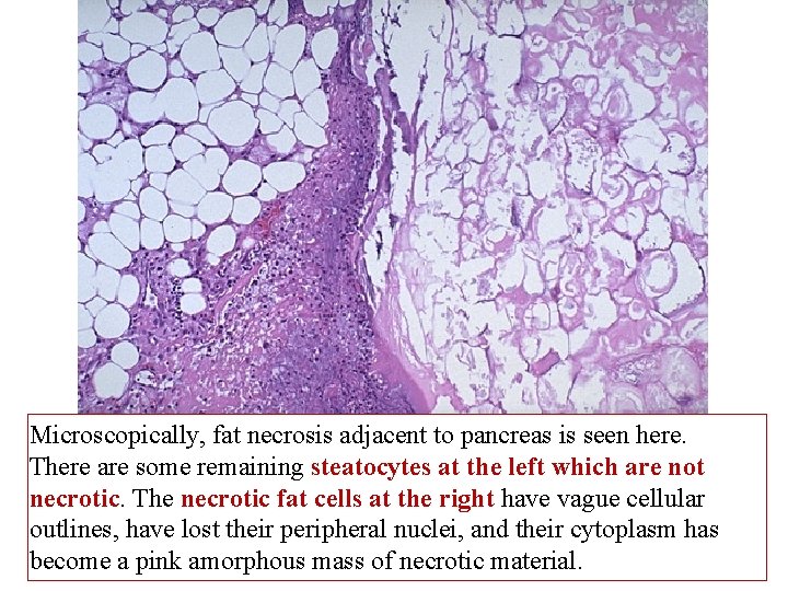 Microscopically, fat necrosis adjacent to pancreas is seen here. There are some remaining steatocytes