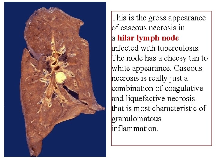 This is the gross appearance of caseous necrosis in a hilar lymph node infected