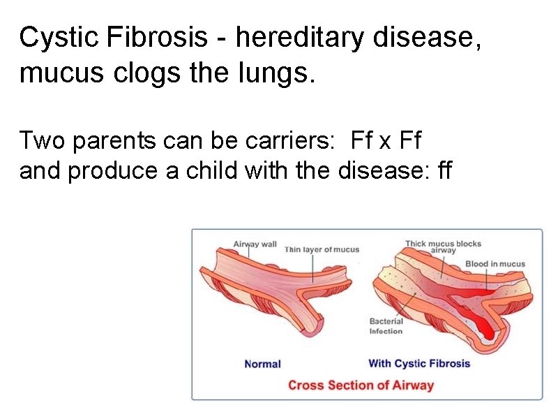 Cystic Fibrosis - hereditary disease, mucus clogs the lungs. Two parents can be carriers: