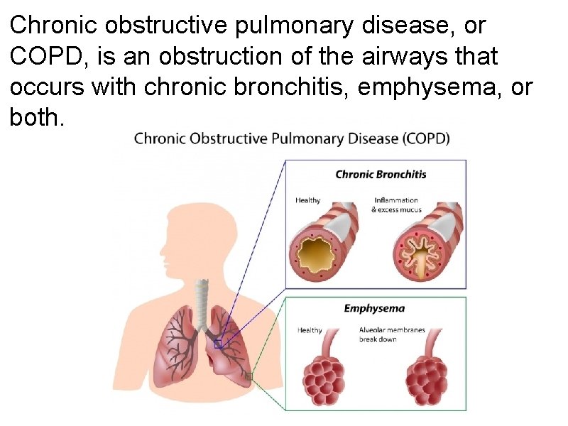 Chronic obstructive pulmonary disease, or COPD, is an obstruction of the airways that occurs