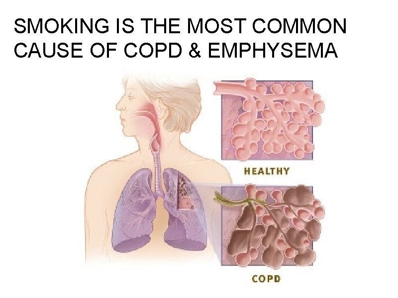SMOKING IS THE MOST COMMON CAUSE OF COPD & EMPHYSEMA 