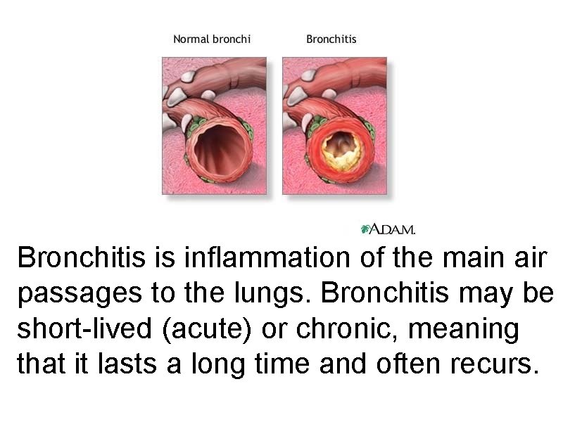 Bronchitis is inflammation of the main air passages to the lungs. Bronchitis may be
