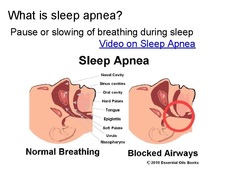What is sleep apnea? Pause or slowing of breathing during sleep Video on Sleep