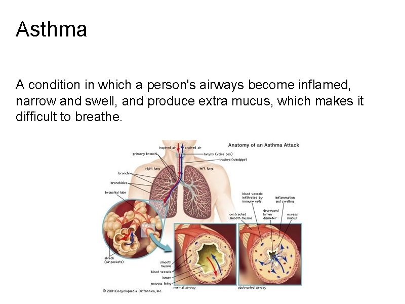 Asthma A condition in which a person's airways become inflamed, narrow and swell, and