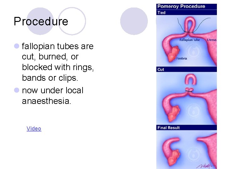 Procedure l fallopian tubes are cut, burned, or blocked with rings, bands or clips.