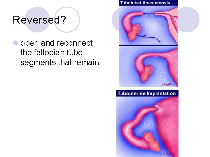 Reversed? l open and reconnect the fallopian tube segments that remain. 