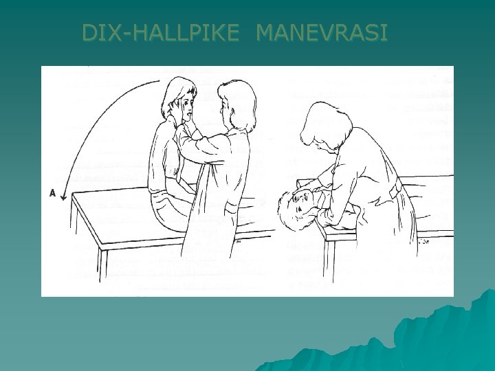 DIX-HALLPIKE MANEVRASI 