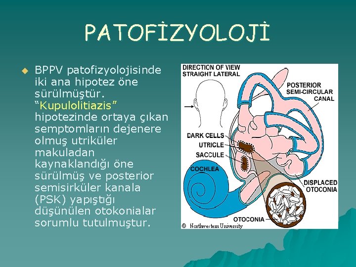 PATOFİZYOLOJİ u BPPV patofizyolojisinde iki ana hipotez öne sürülmüştür. “Kupulolitiazis” hipotezinde ortaya çıkan semptomların