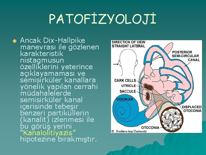 PATOFİZYOLOJİ u Ancak Dix-Hallpike manevrası ile gözlenen karakteristik nistagmusun özelliklerini yeterince açıklayamaması ve semisirküler