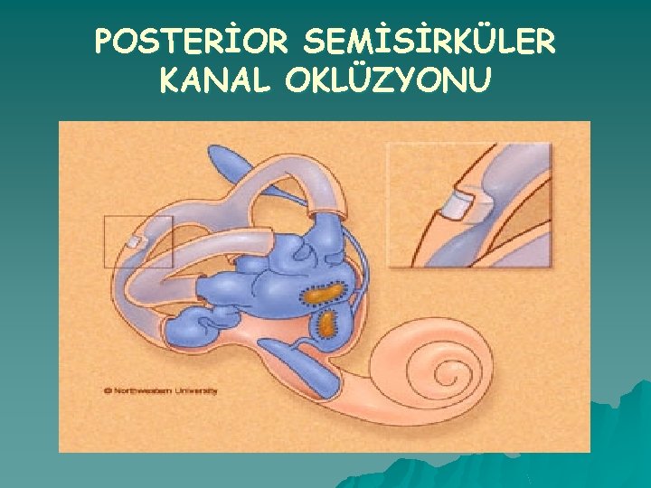 POSTERİOR SEMİSİRKÜLER KANAL OKLÜZYONU 